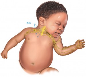 brachialplexus1 300x269
