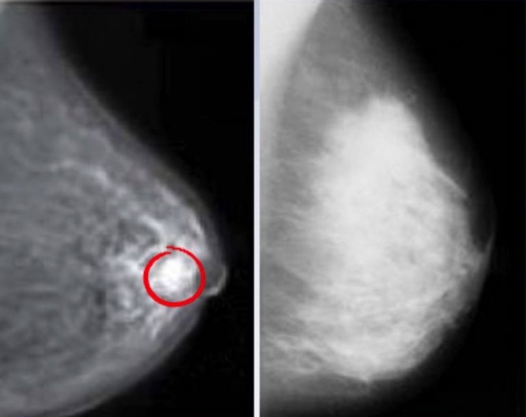 Dense Breast Tissue Obscures the Detection of Cancer